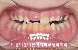 수술후