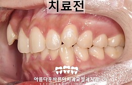 수술전