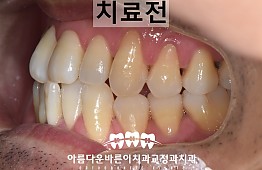 수술전