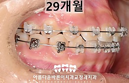 수술후