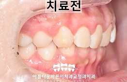 수술전