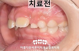 수술전