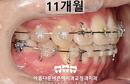 수술후