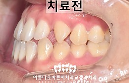 수술전