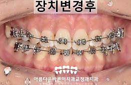수술후