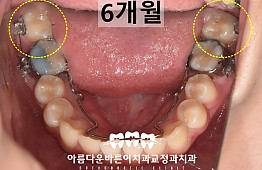 수술후