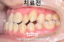 수술전