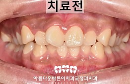 수술전