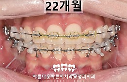 수술후