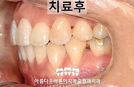 수술후