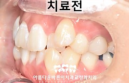 수술전