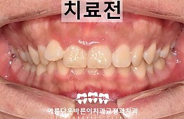 수술전