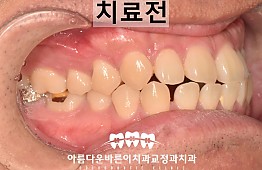 수술전