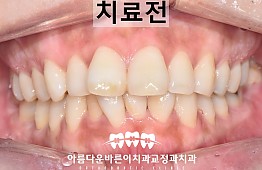 수술전