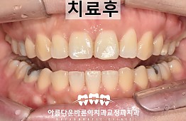 수술후