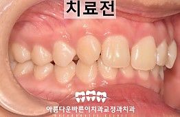 수술전