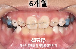 수술후