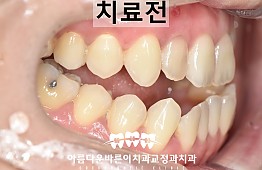 수술전