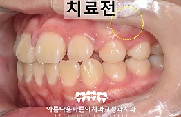 수술전