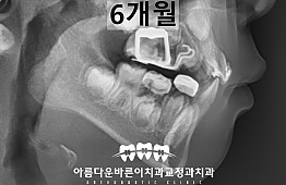 수술후