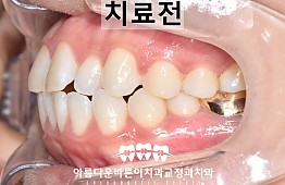 수술전