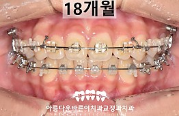 수술후