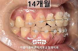 수술후