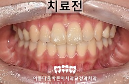 수술전