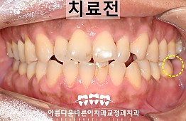 수술전