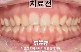 수술전