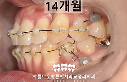 수술후