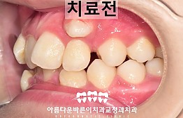 수술전