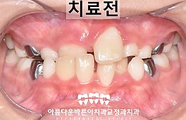 수술전