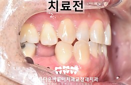 수술전