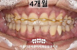 수술후