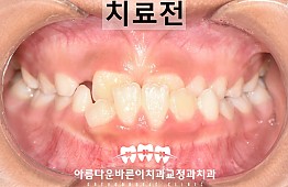 수술전