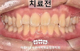 수술전