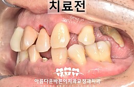 수술전