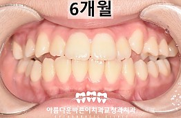 수술후
