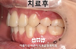 수술후