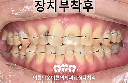 수술후