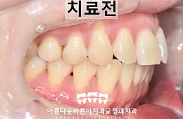 수술전