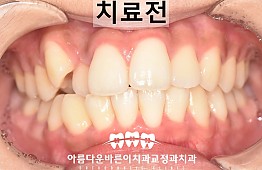 수술전