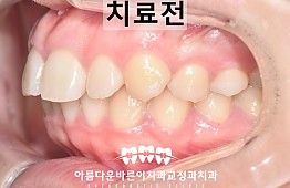 수술전