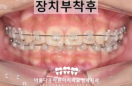 수술후