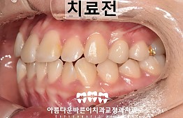 수술전