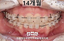 수술후