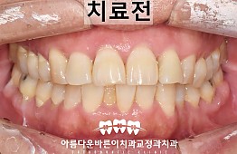 수술전