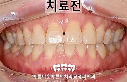 수술전