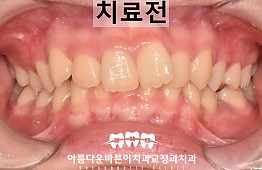 수술전